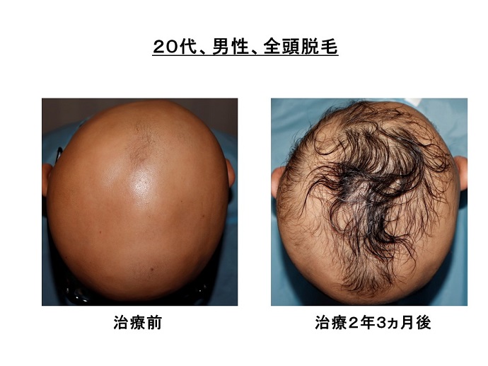 円形脱毛症　病院